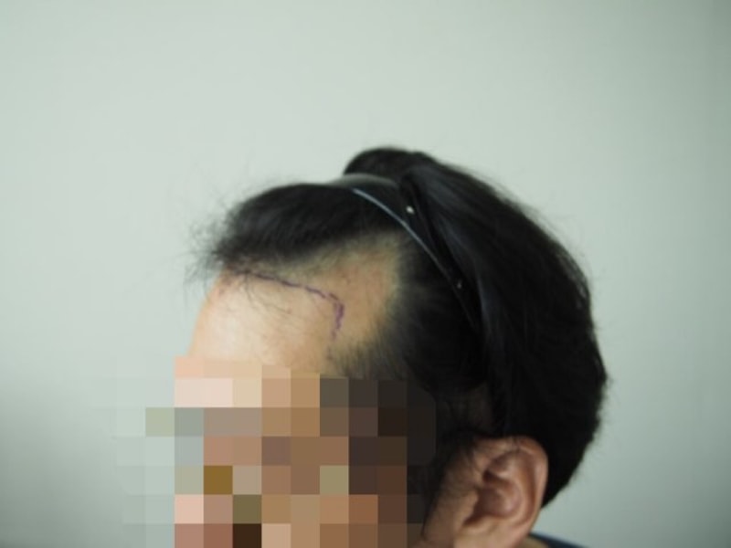 수술 전 디자인2.jpg