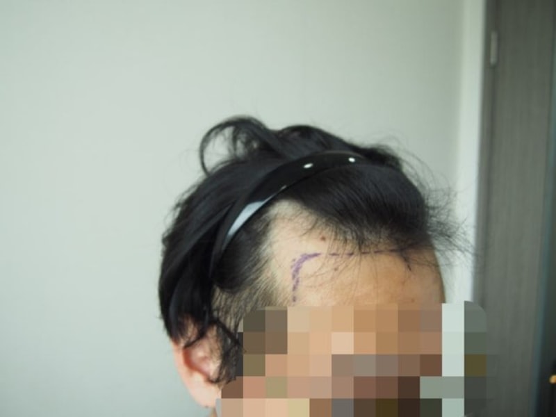 수술 전 디자인1.jpg