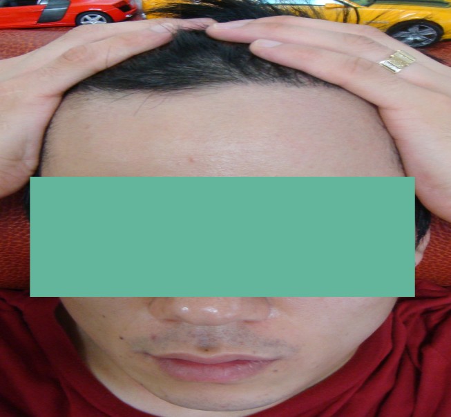 모발이식.jpg