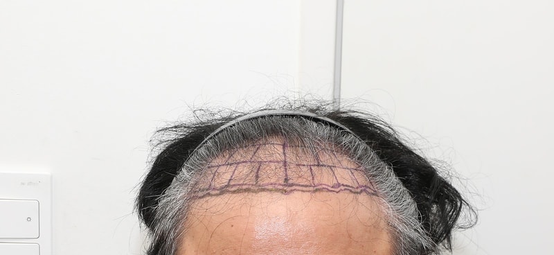 뉴헤어 서울점 절개 모발이식 2000모낭 6개월차 후기
