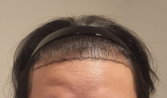뉴헤어 서울점 비절개 1200모낭(2400모) 7일차 후기