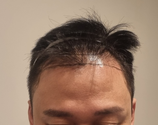 뉴헤어 서울점 비절개 1800모낭(3600)모 후기