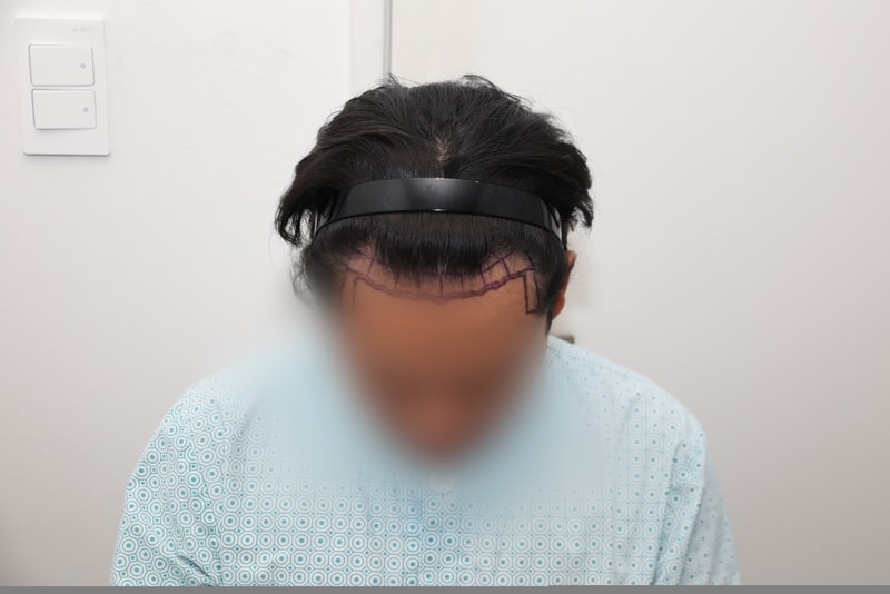 뉴헤어 서울점 절개 1800모낭(3600모) 3일차