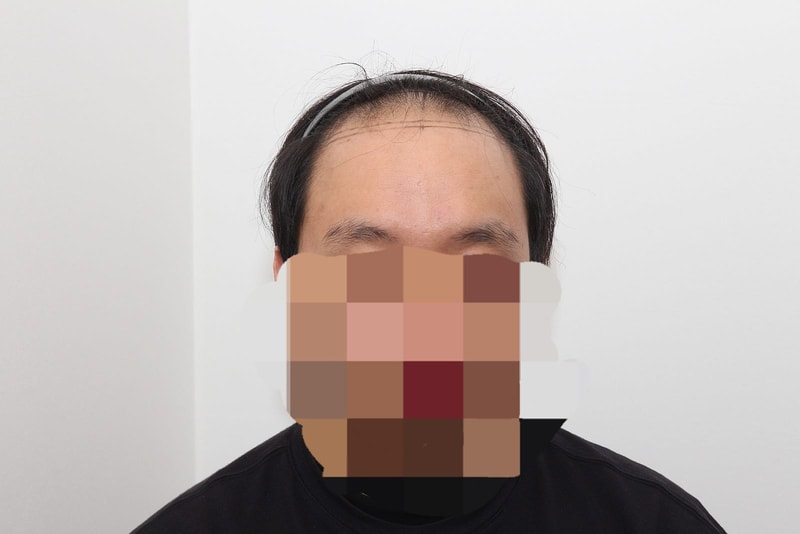 뉴헤어 비절개 모발이식 6개월차 후기 입니다. (2000모낭,4000모)