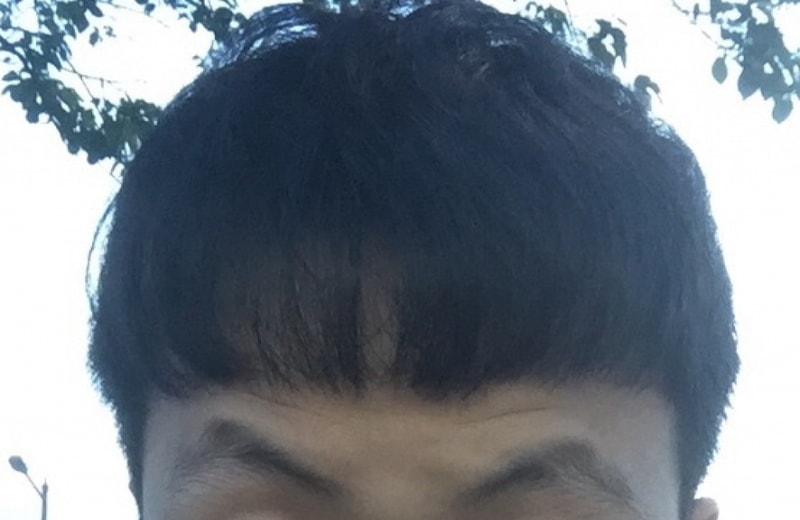 Hair loss escape Late motion 3000 hair follicles 17 months (downed hair)