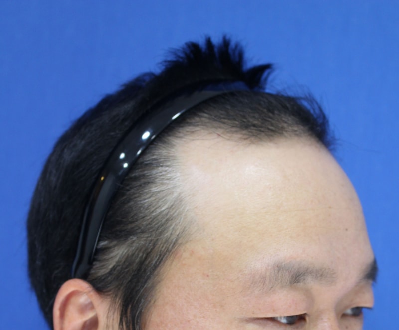 5. 수술전.jpeg