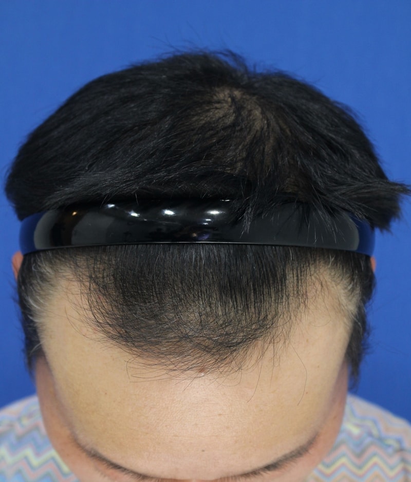 3. 수술전.jpeg