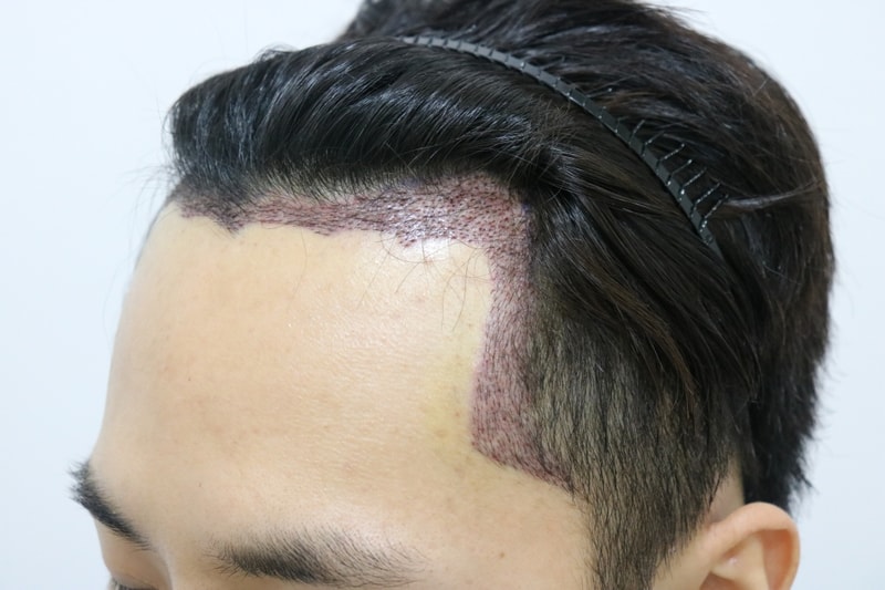 비절개 2488 헤어라인교정