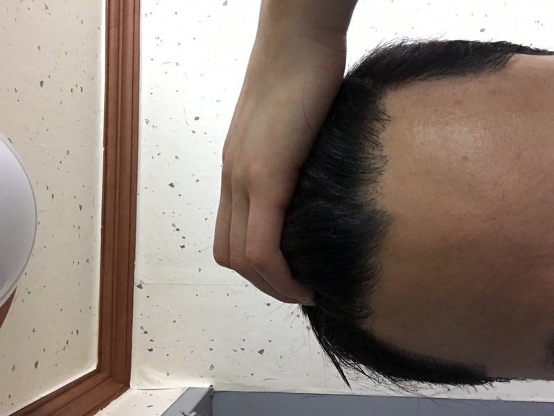 비절개 M자 헤어라인교정 8개월