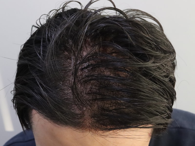 수술 다음날2.JPG