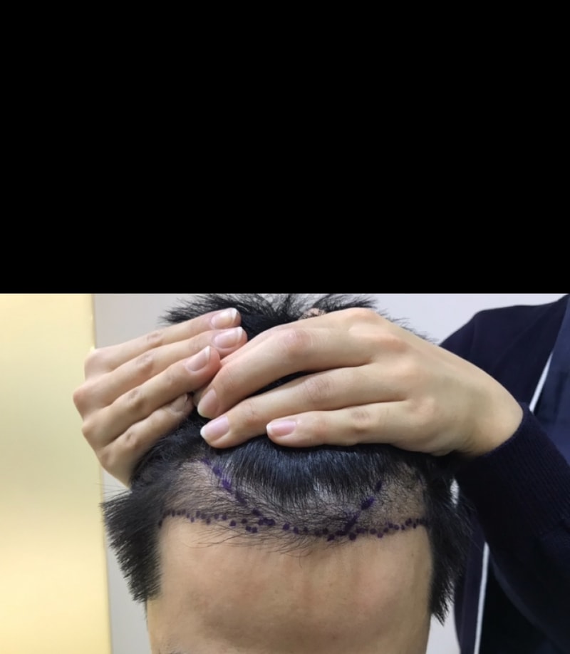 비절개 6개월 후기 입니다