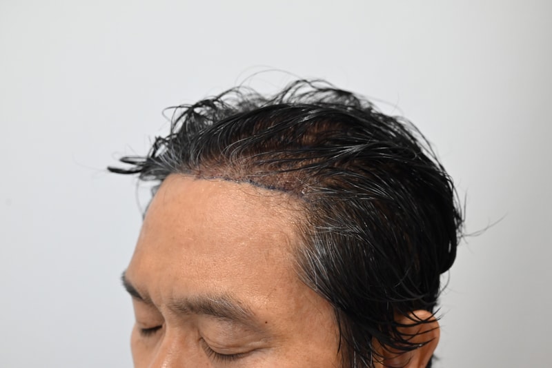 3.수술후.jpg
