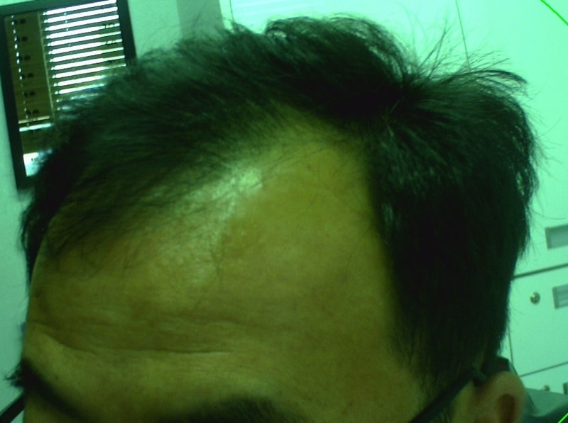 모발이식전 (2).jpg