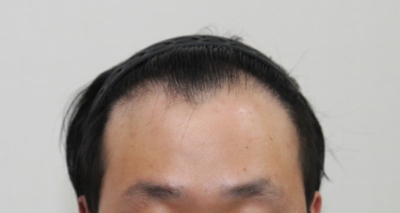 nhi뉴헤어 1539모낭 비절개 1년6개월만에 올리는 후기입니다