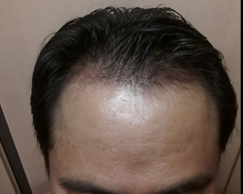 150224 44일경과.jpg