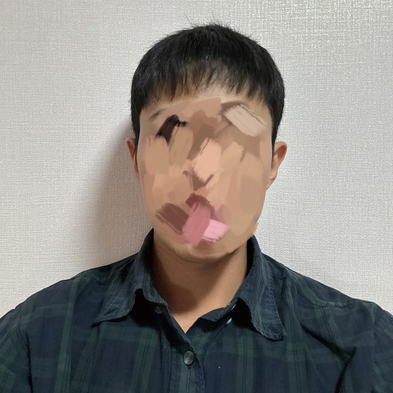 ★모모성형외과 비절개 모발이식 1년 경과 후기 가즈아~>.<