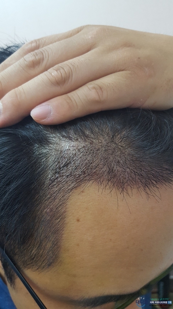This is the report of the three-month progress of the 3,000-mo incision.
