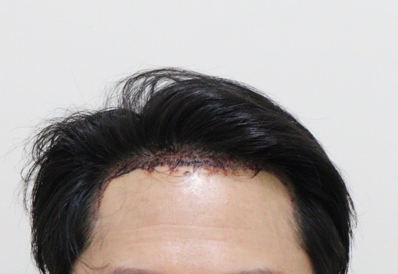 2. 수술후_1일.JPG