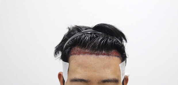 시술직후 라인.PNG