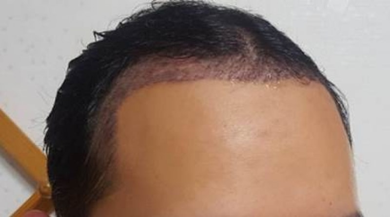 딱지제거 후.jpg