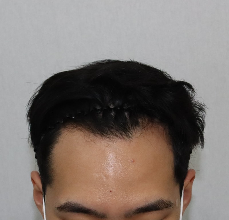 비절개 모발이식 1년 후기 / 3000모 / M자 / 줄삭 / 20대 남자