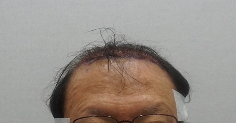 수술직후 정면.jpg