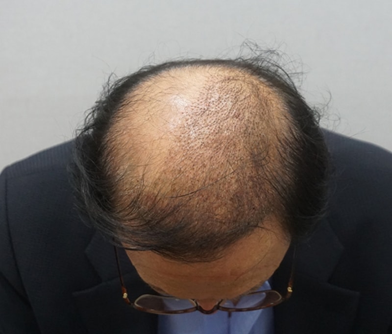 수술후10일 실밥제거.jpg