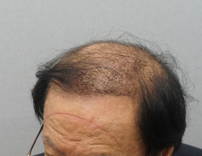 수술후10일1.jpg