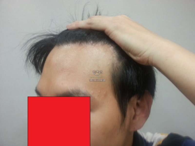 수술전1.jpg