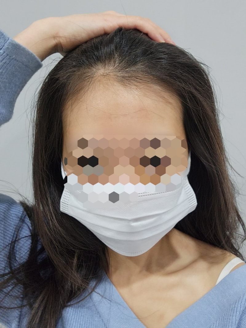 오늘 헤어라인 모발이식 했어요