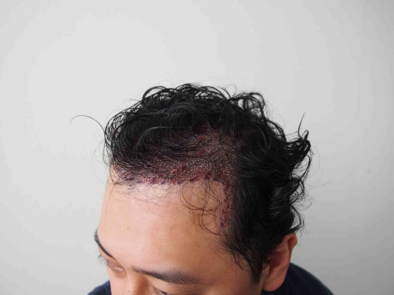수술직후 3.JPG