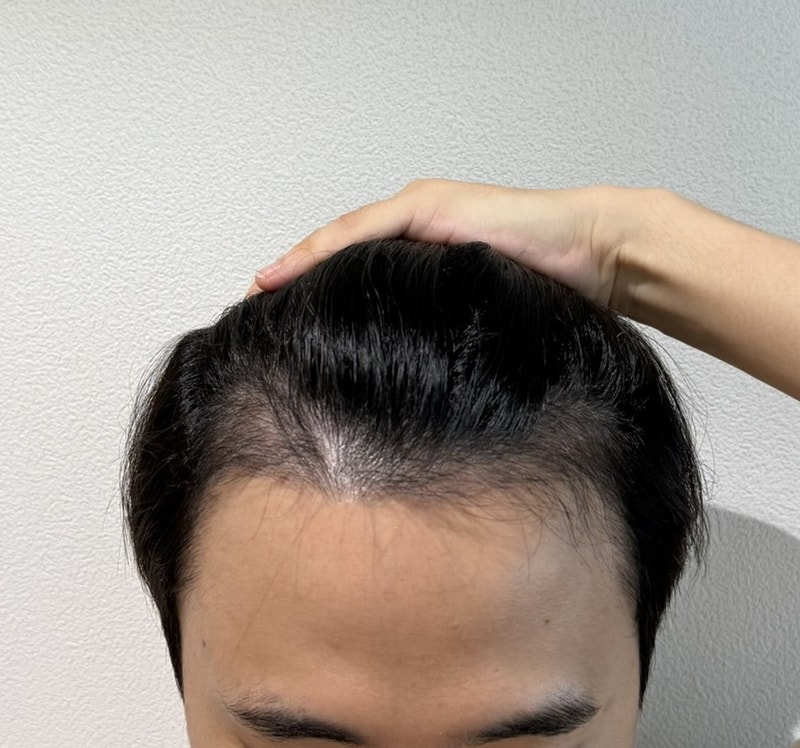 이식후__3개월_정면.JPEG