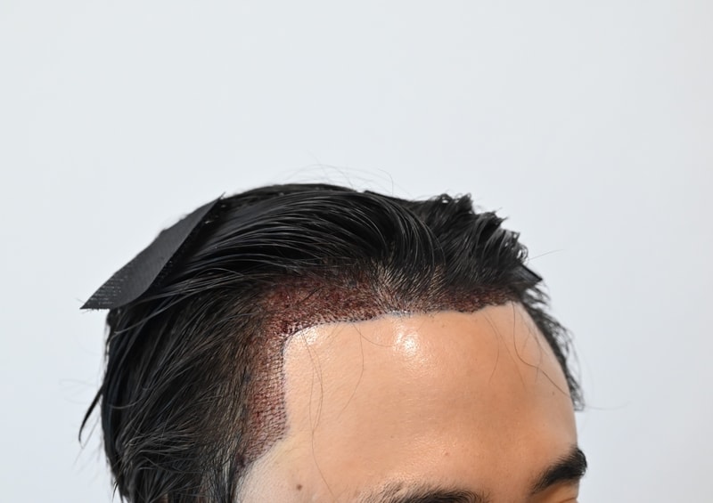 이식후_측면.JPEG