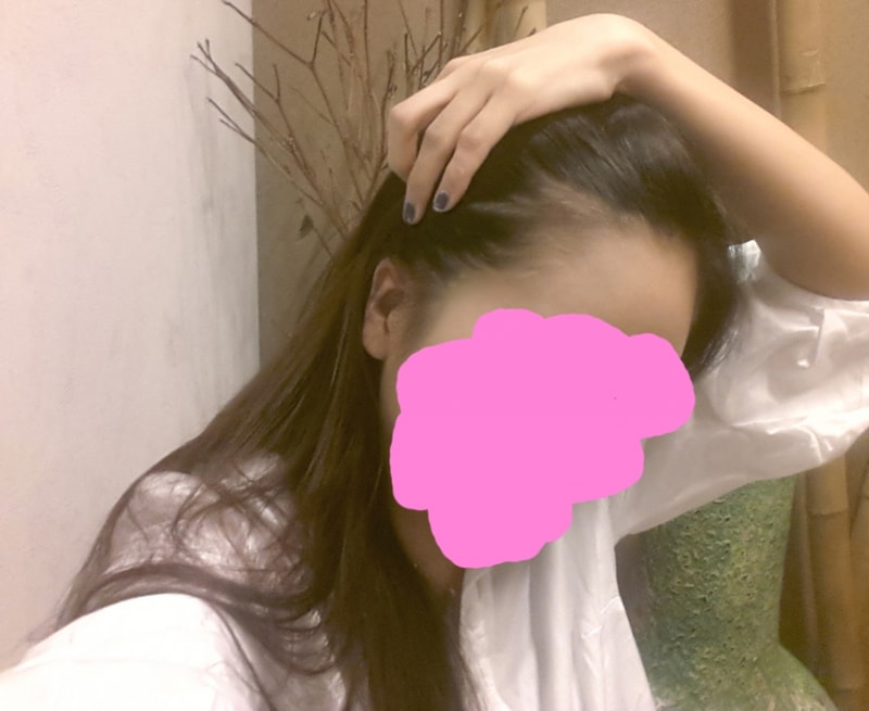 절개법 2000모 제이피성형외과 헤어라인 후기 남겨봅니다♥