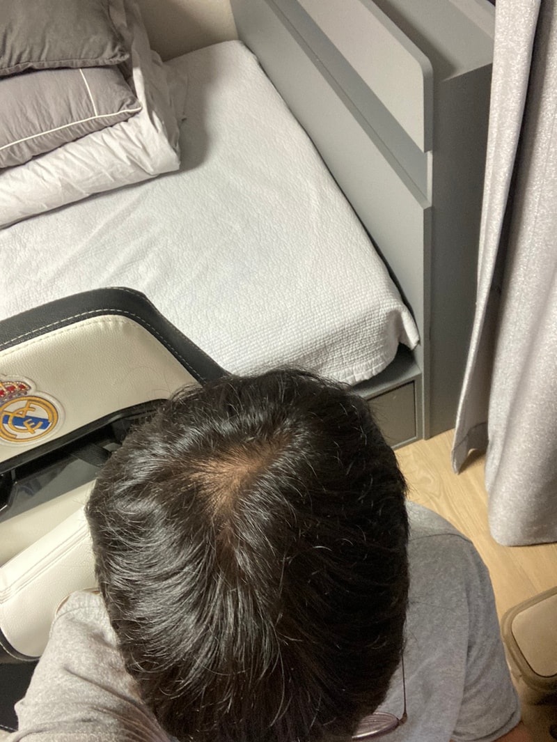 강남 ㄴㅎㅇ 정수리 모발이식 2일차 후기입니다(TMI주의)