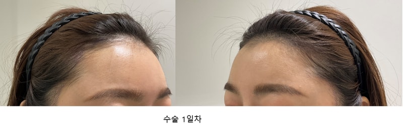 수술1일차.jpg