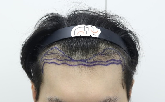 압구정 맘모스헤어라인 모발이식 1일차 후기