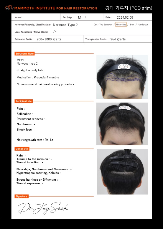 압구정 맘모스헤어라인 모발이식 4개월차 후기