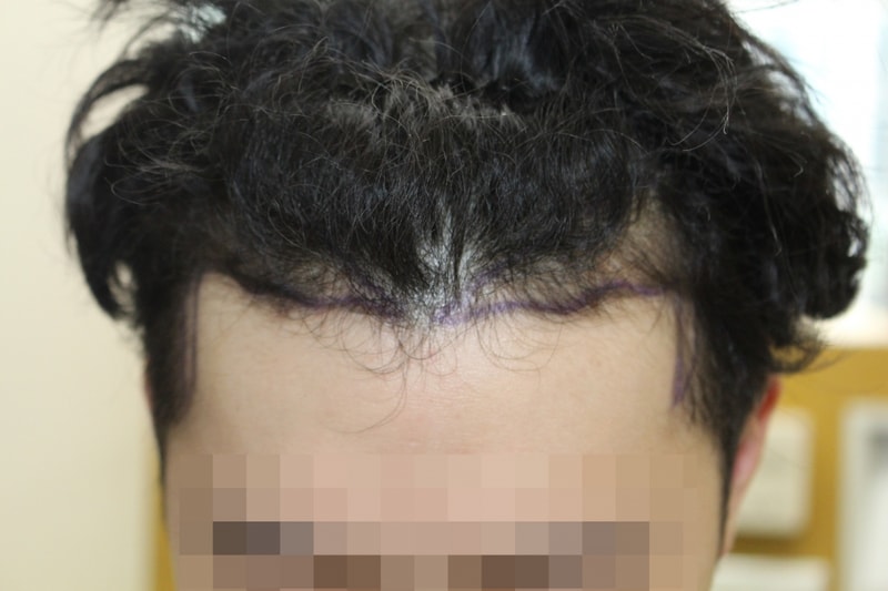 수술전 다자인.JPG