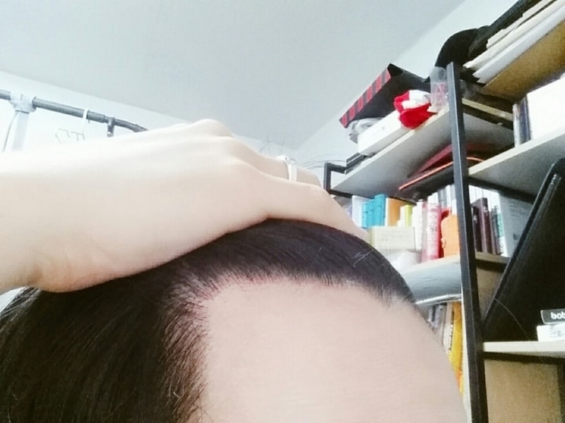 수술 후 (오른쪽).jpg