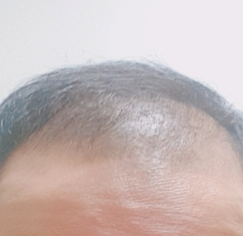 시술전.jpg