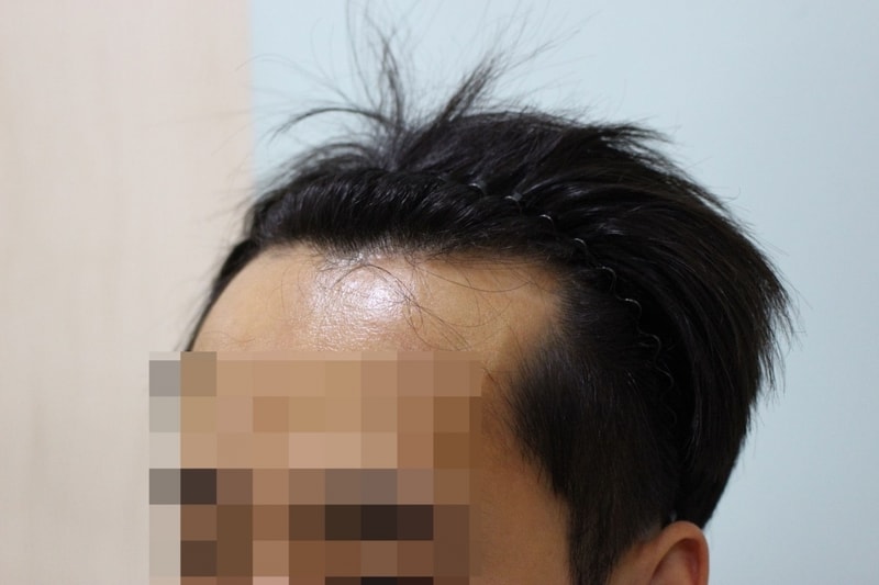 수술전허전한내머리2.jpg