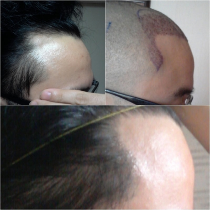 7 months of hair transplantation in Korea.. ' - '