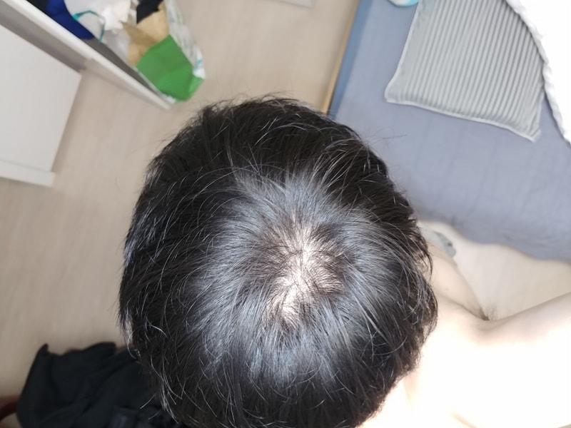 정수리 숱보강