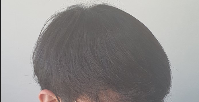 비절개 2090모낭 1년차 후기
