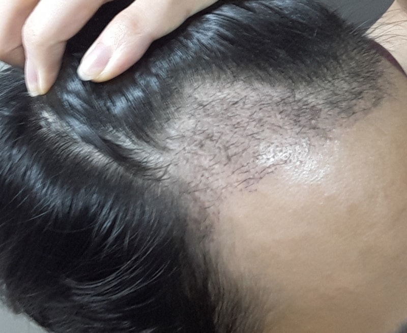 Day 30 of Hair Transplantation / Day 30 of Avodat