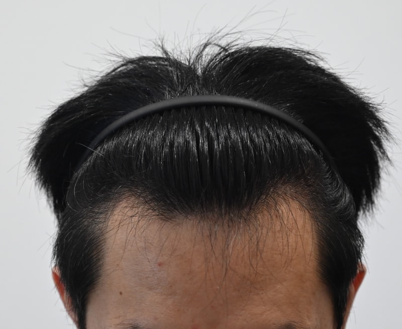 모엠의원 비절개 2700모 이식 1년 후기