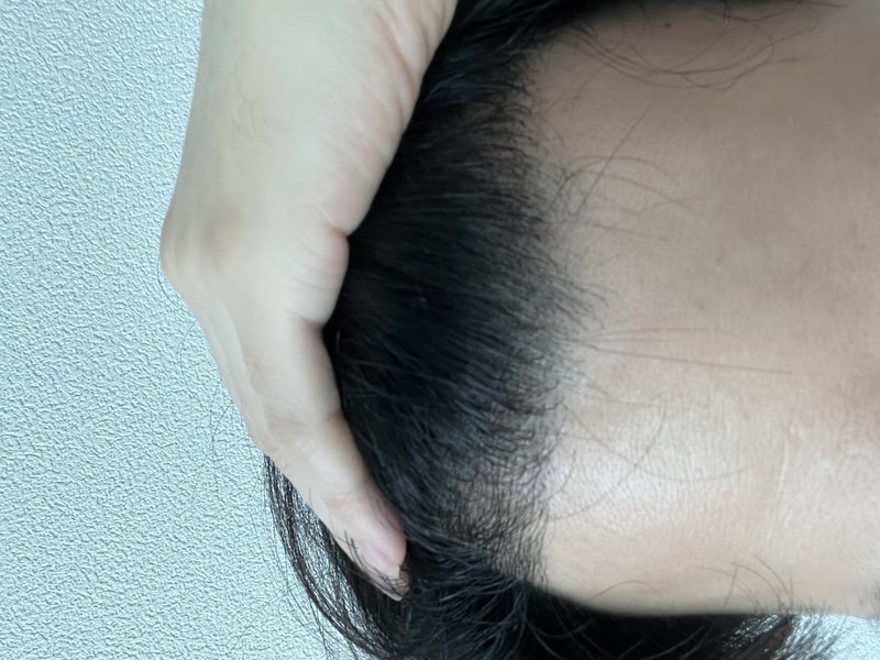 모재성 성형외과 8개월차 후기입니다.