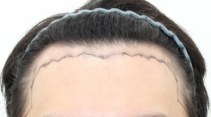 Shin Sinsa Station, Mopro Clinic, Director of Mungeon Academy, 4089 mother hair transplant, 16th day review
