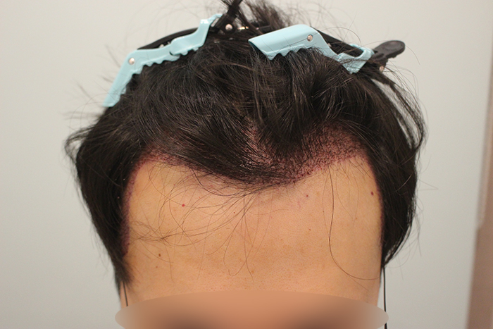 수술후 1일 (2).JPG